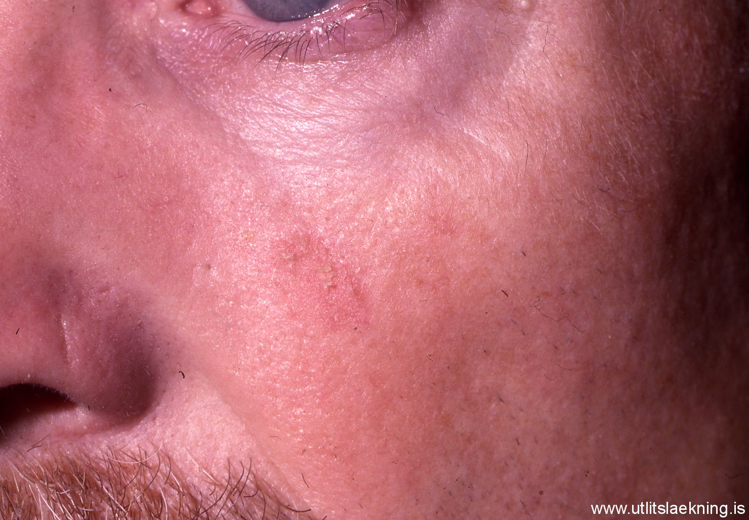 Actinic Keratosis Pictures and Photos