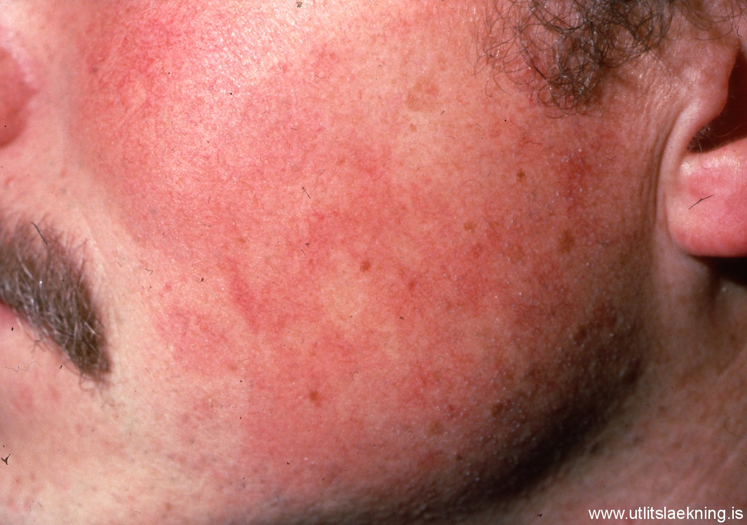 Keratosis Pilaris: Cause, Treatments, and Prevention - WebMD