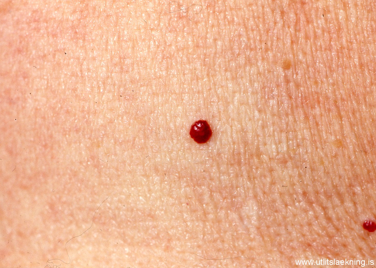angioma pictures
