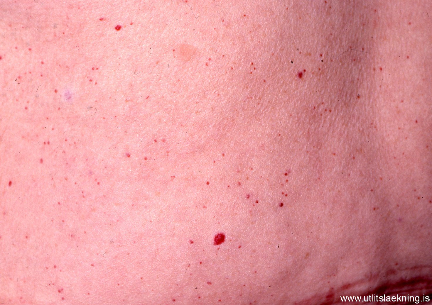Melanoma As Related To Cherry Angioma Pictures
