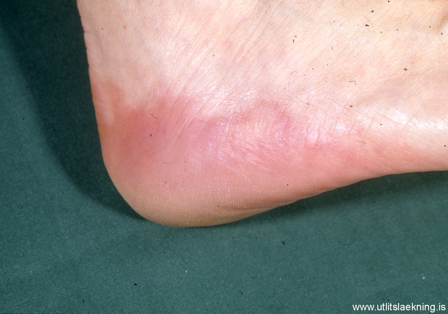 Photo Quiz: Foot Bumps: Now You See Them, Now You Don't ...