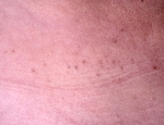 acantholytic-epidermal-naevus-linear-darier-disease