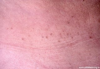 copy_0_acantholytic-epidermal-naevus-linear-darier-disease