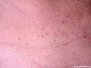 Acantholytic epidermal naevus (Linear Darier disease)