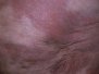 Acrodermatitis chronica atrophicans