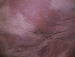acrodermatitis-chronica-atrophicans-6