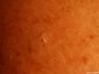 Actinic keratosis
