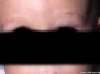 Æðaæxli (hemangioma)
