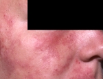 axli-hemangioma-planus
