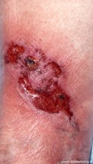 copy_0_akomudrep-pyoderma-gangrenosum