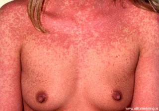 copy_0_autoimmune-progesterone-dermatitis