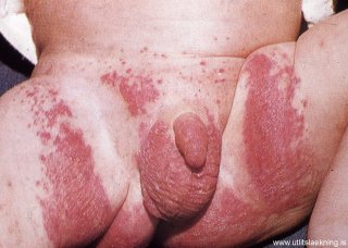 copy_0_bleyjuexem-diaper-dermatitis