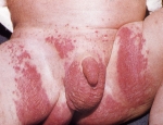 copy_0_bleyjuexem-diaper-dermatitis