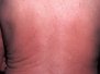 Eitlaæxli (lymphoma)