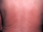 roi-axli-erythroderma-caused-by-a-lymphoma