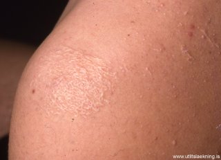 elastosis-perforans-serpiginosa
