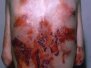 Epidermolysis bullosa dystrophica