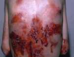 epidermolysis-bullosa-dystrophica-2