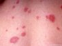 Erythema annulare centrifugum