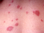 erythema-annulare-centrifugum-iii