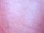 Erythema chronicum migrans og Acrodermatitis chronica atropicans