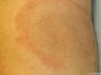 Erythema chronicum migrans