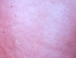 erythema-chonicum-migrans-1