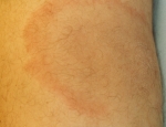 erythema-chonicum-migrans-4