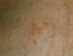 myntref-eczema-nummularis-3
