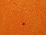 nevus-vg-atypia