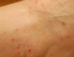 lichenplanus5