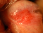 erythroplasia-og-queyrat-flguekjukrabbamein-penis-sri-myndinni-er-eftir-snatku