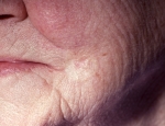 grunnfrumukrabbamein-af-morphea-ger-morpheaform-basal-cell-carcinoma