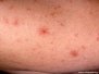 Háræðastjarna (spider nevus)