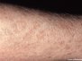 Hreisturhúð (ichthyosis)