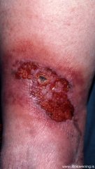 abolga-sjogrens-sjogrens-vasculitis