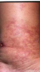 abolgusar-vasculitis-ulcer