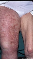 asarkmein-angiosarcoma