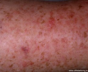epidermolysis-dysplasia-verruciformis
