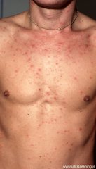 hlaupabola-varicella