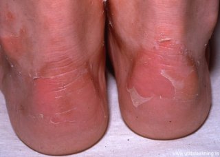 inherited-epidermolysis-bullosa-ser-grein-enginn-texti
