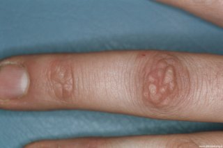 knuckle-pads