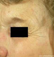 laser-ellivortur-mynd01-eftir
