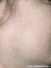 laser-ellivortur-mynd02-eftir