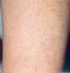 laser-gegnblettum-mynd05-eftir