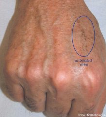 laser-gegnblettum-mynd06-eftir