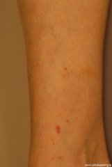 leukocytoclastic-vasculitis