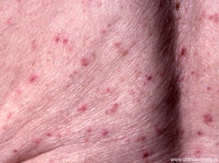 lichenoid-lyfjasvorun-drug-lichenoid-toxicodermatitis