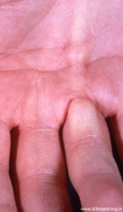 lofakreppa-dupuytrens-contracture