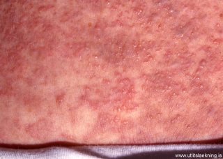 meinvorp-fra-ristli-colon-metastasis